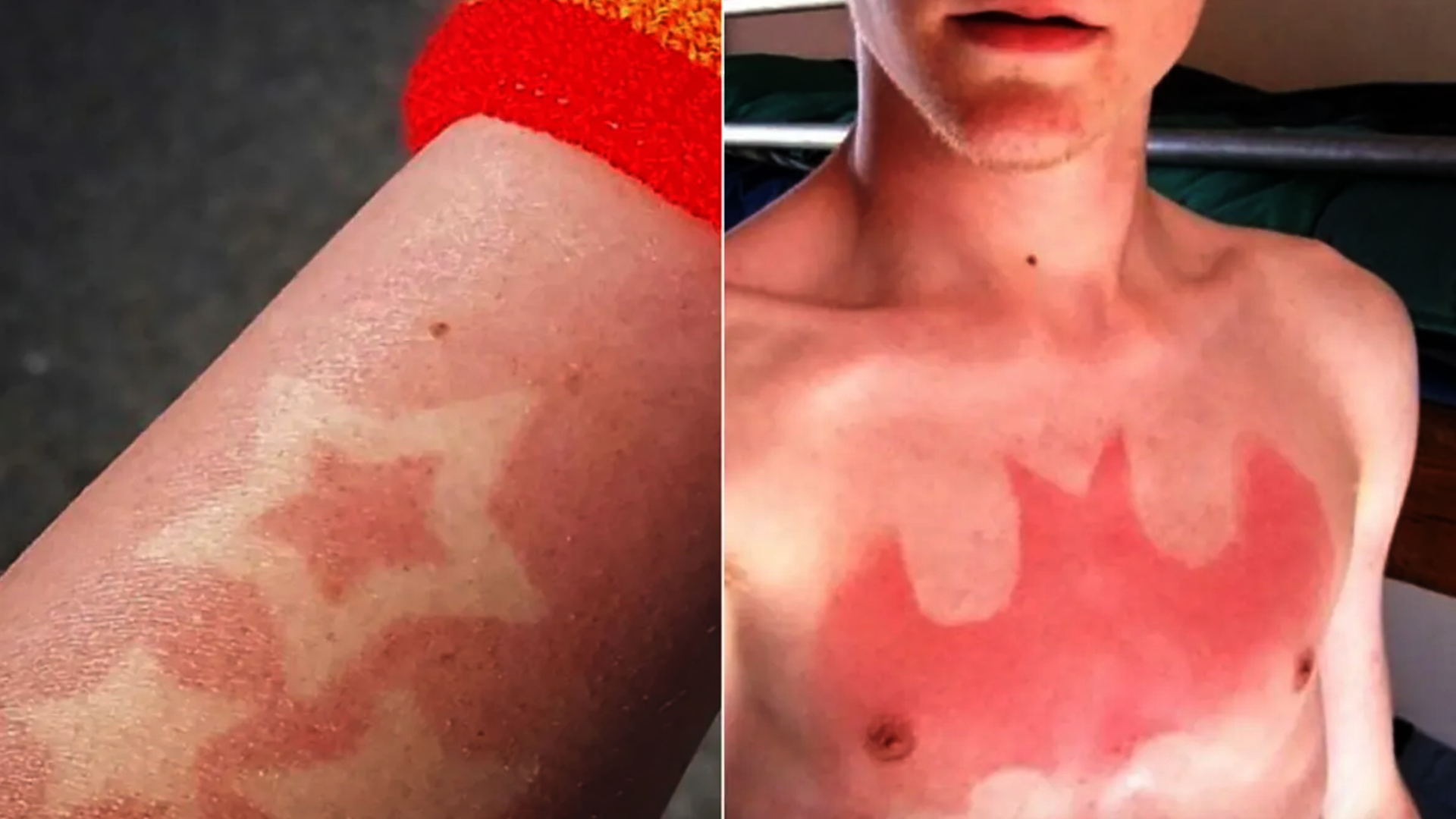 sunburn challenge la sfida che brucia la pelle l8217ultima follia dei social